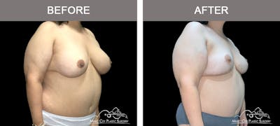 Breast Lift Before & After Gallery - Patient 418674 - Image 2