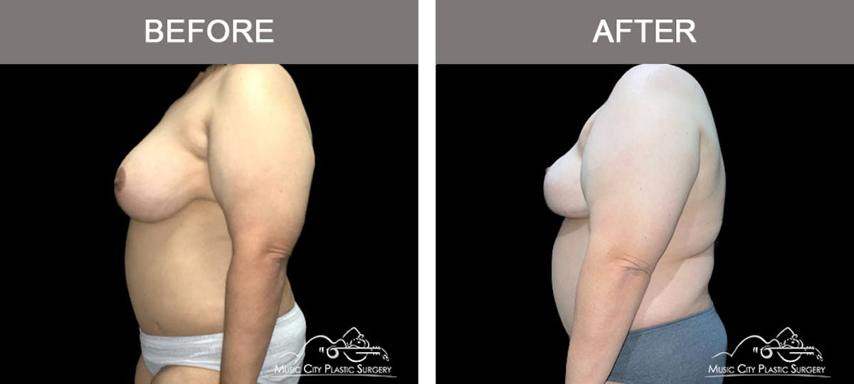 Liposuction Before & After Gallery - Patient 150502 - Image 5