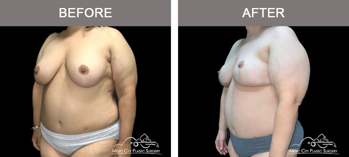 Capsulectomy Before & After Gallery - Patient 111834 - Image 4