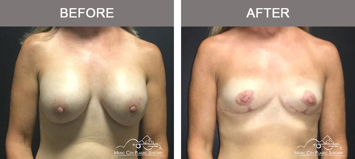 Breast Lift Before & After Gallery - Patient 121737 - Image 1