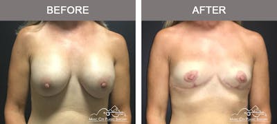 Capsulectomy Before & After Gallery - Patient 392792 - Image 1