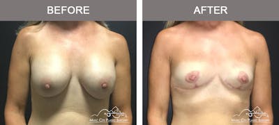Capsulectomy Before & After Gallery - Patient 392792 - Image 1