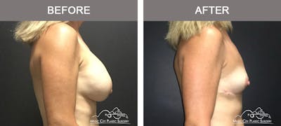 Capsulectomy Before & After Gallery - Patient 392792 - Image 3
