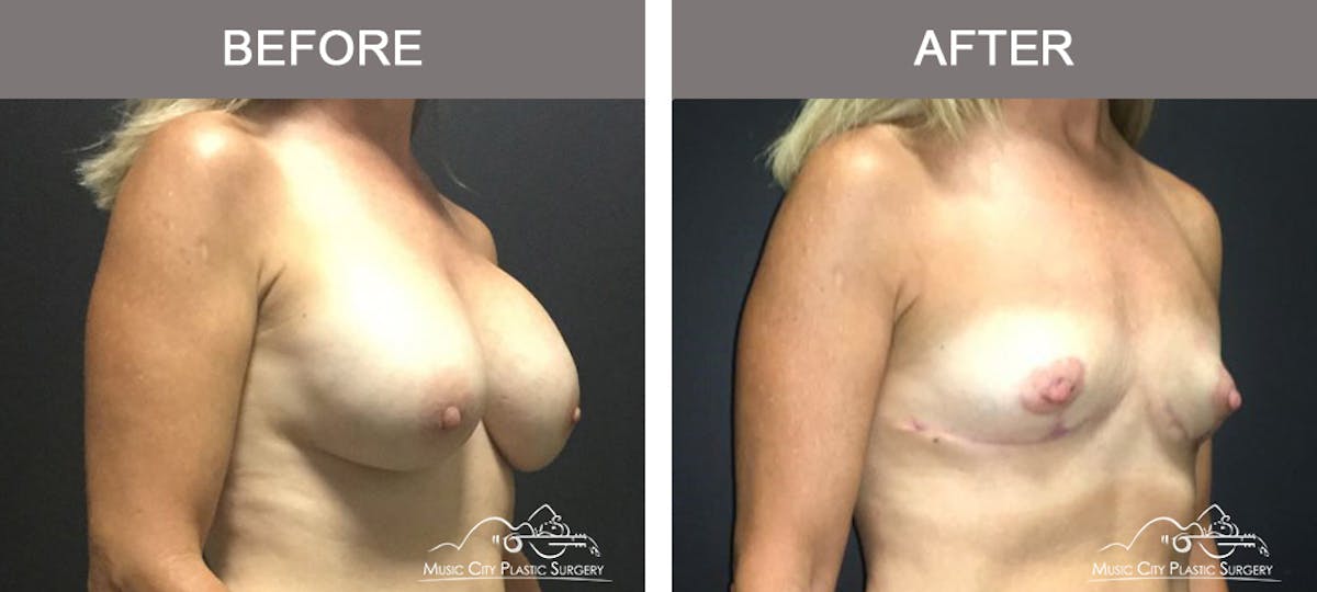 Capsulectomy Before & After Gallery - Patient 392792 - Image 2
