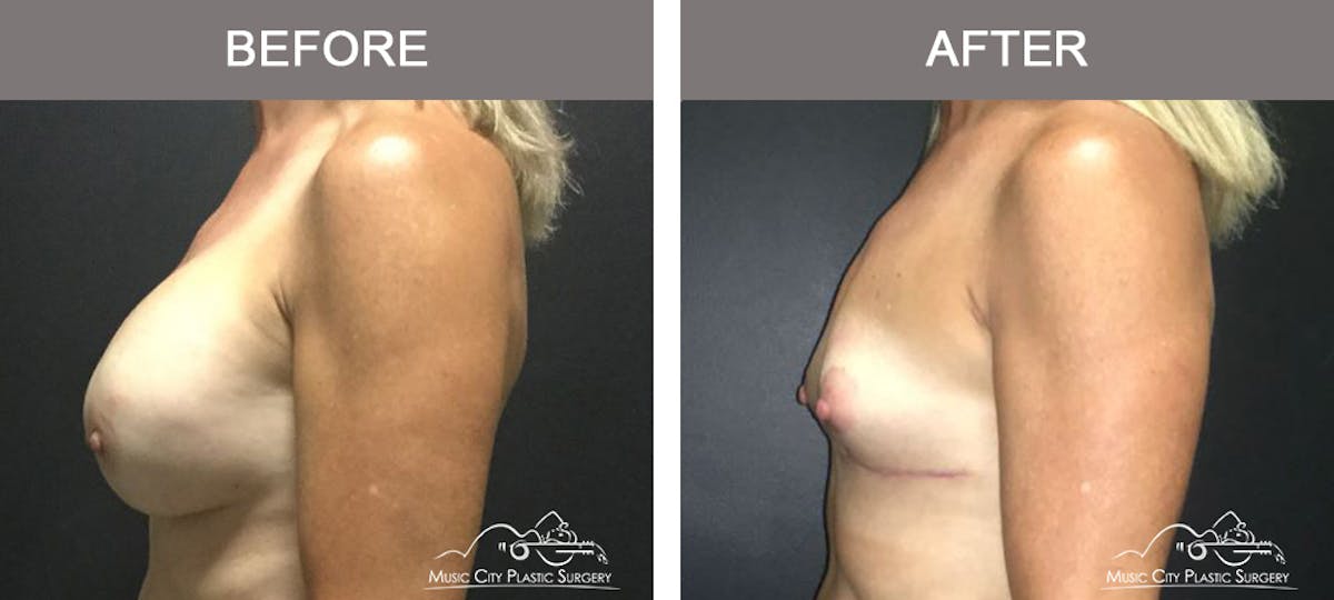 Capsulectomy Before & After Gallery - Patient 392792 - Image 5