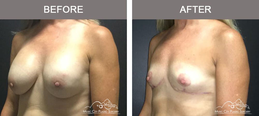 Capsulectomy Before & After Gallery - Patient 392792 - Image 4