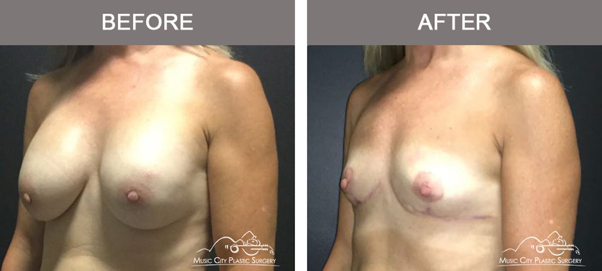 Capsulectomy Before & After Gallery - Patient 392792 - Image 4