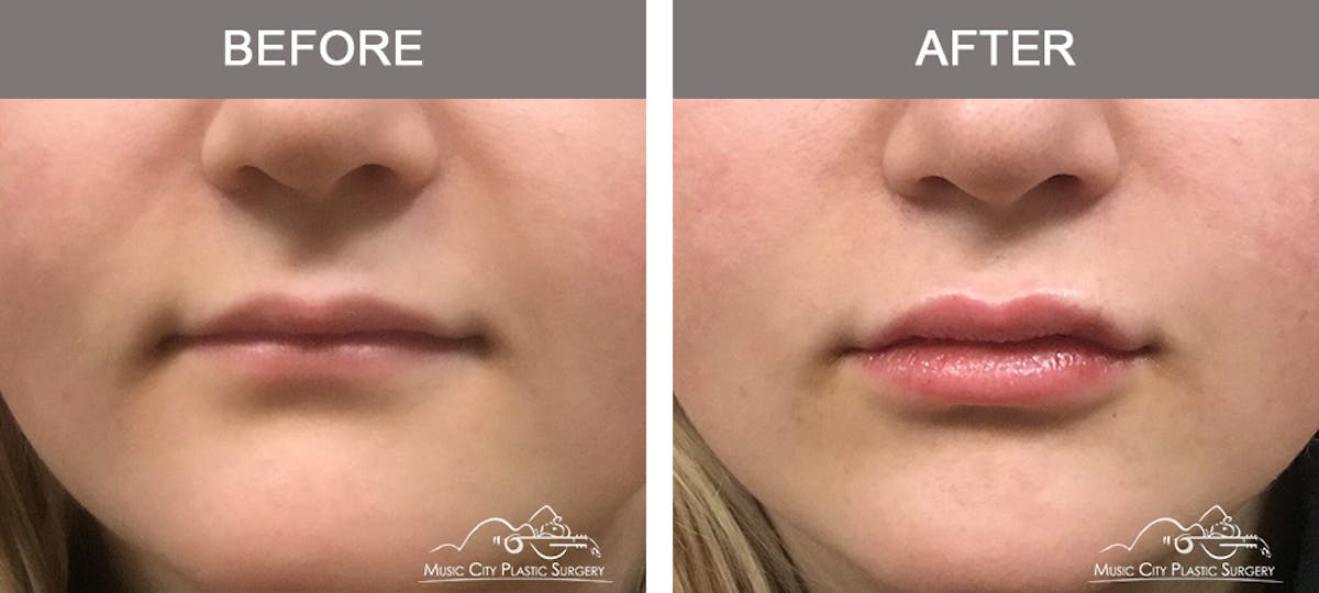 Dermal Fillers Before & After Gallery - Patient 374769 - Image 1