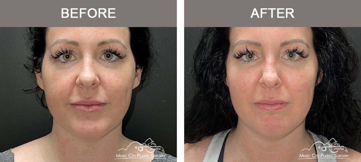 Dermal Fillers Before & After Gallery - Patient 136802 - Image 1