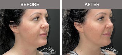 Dermal Fillers Before & After Gallery - Patient 136802 - Image 2