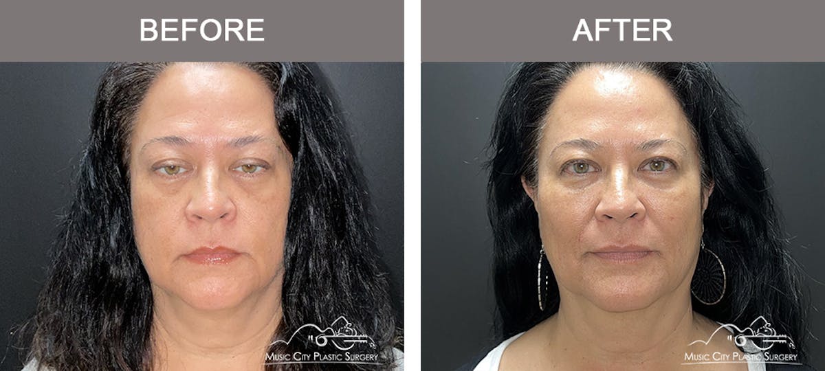 Dermal Fillers Before & After Gallery - Patient 264100 - Image 1