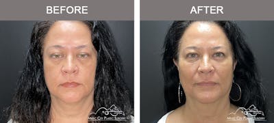 Dermal Fillers Before & After Gallery - Patient 264100 - Image 1