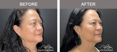 Dermal Fillers Before & After Gallery - Patient 264100 - Image 2
