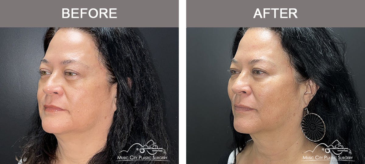 Dermal Fillers Before & After Gallery - Patient 264100 - Image 3