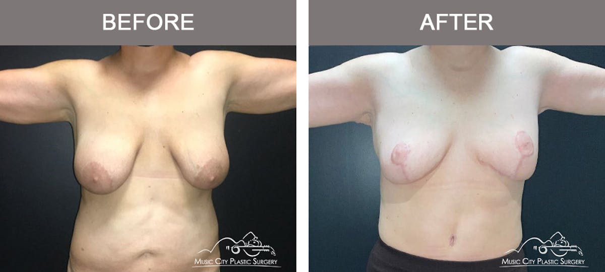 Liposuction Before & After Gallery - Patient 129477 - Image 1
