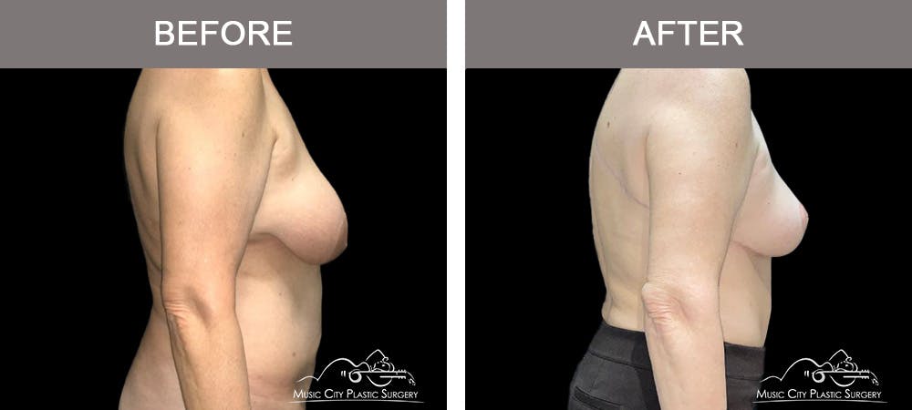 Liposuction Before & After Gallery - Patient 129477 - Image 3