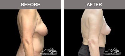 Breast Lift Before & After Gallery - Patient 217363 - Image 3