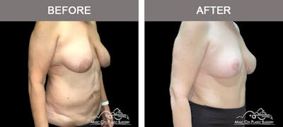 Breast Reduction Before & After Gallery - Patient 662218 - Image 2