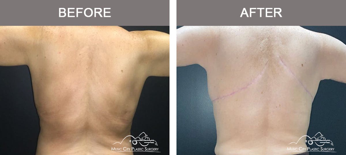 Arm Lift Before & After Gallery - Patient 155666 - Image 6