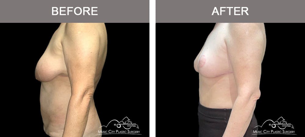Liposuction Before & After Gallery - Patient 129477 - Image 5