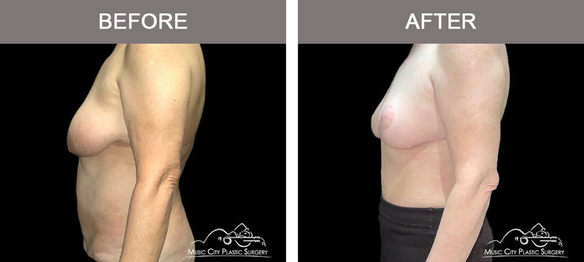 Abdominoplasty Before & After Gallery - Patient 221976 - Image 5