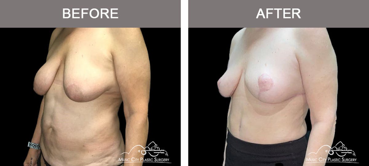 Liposuction Before & After Gallery - Patient 129477 - Image 4