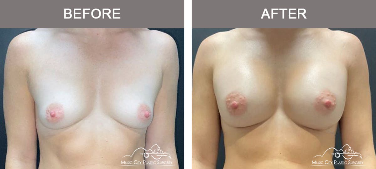 Breast Augmentation Before & After Gallery - Patient 138478 - Image 1