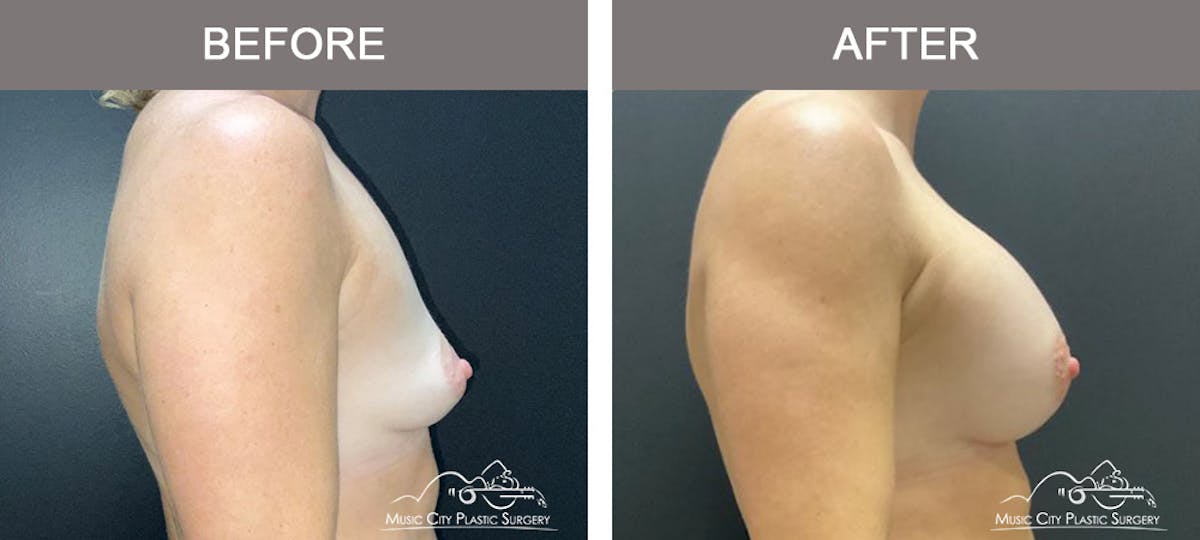 Breast Augmentation Before & After Gallery - Patient 138478 - Image 3
