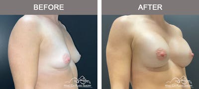 Breast Augmentation Before & After Gallery - Patient 138478 - Image 2