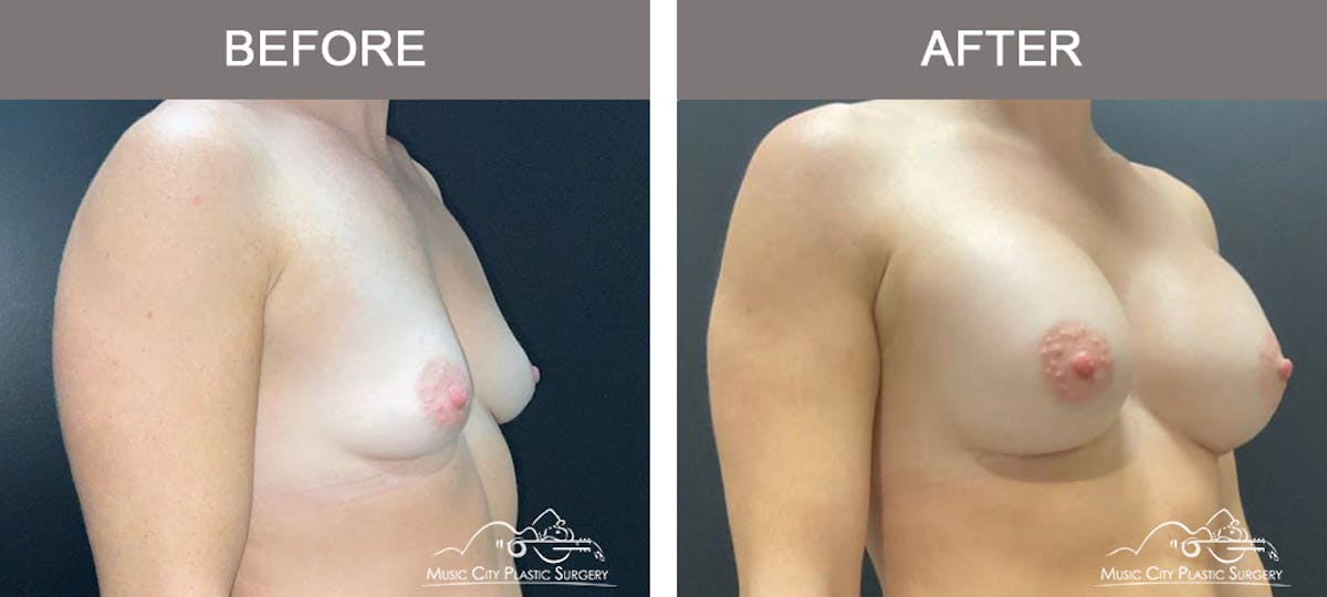 Breast Augmentation Before & After Gallery - Patient 138478 - Image 2