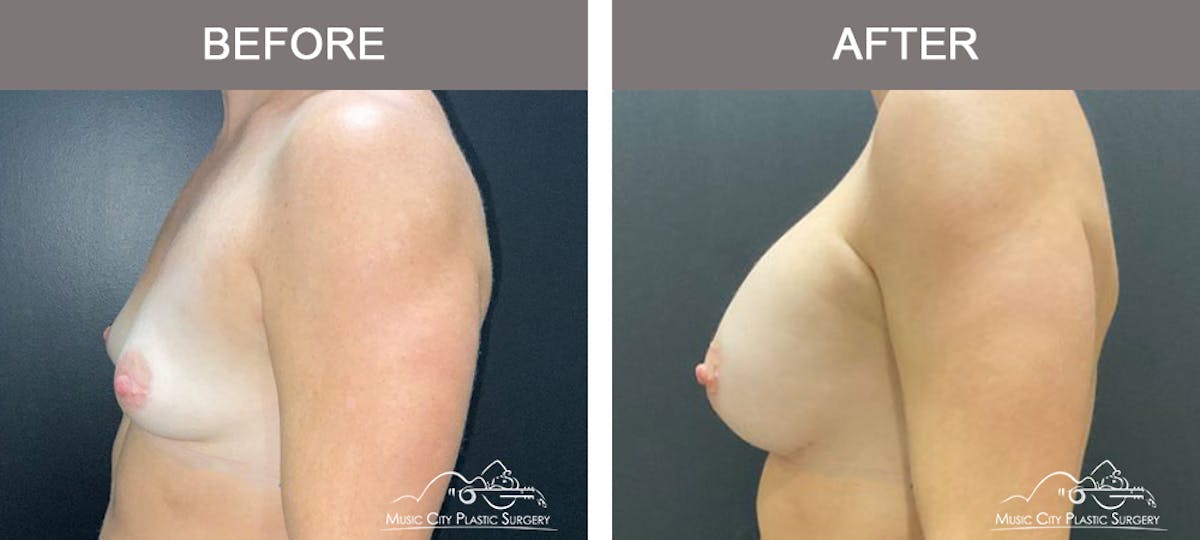 Breast Augmentation Before & After Gallery - Patient 138478 - Image 5