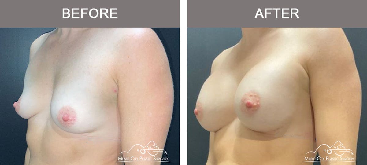 Breast Augmentation Before & After Gallery - Patient 138478 - Image 4