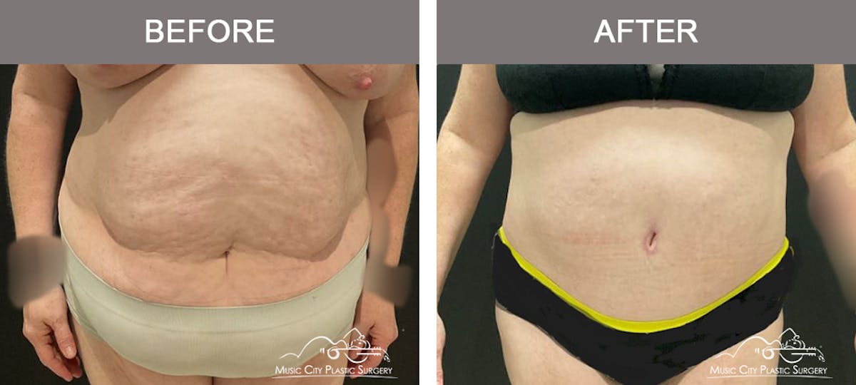 Liposuction Before & After Gallery - Patient 421183 - Image 1