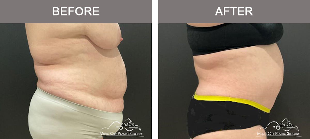 Liposuction Before & After Gallery - Patient 421183 - Image 3