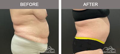 Abdominoplasty Before & After Gallery - Patient 198850 - Image 3