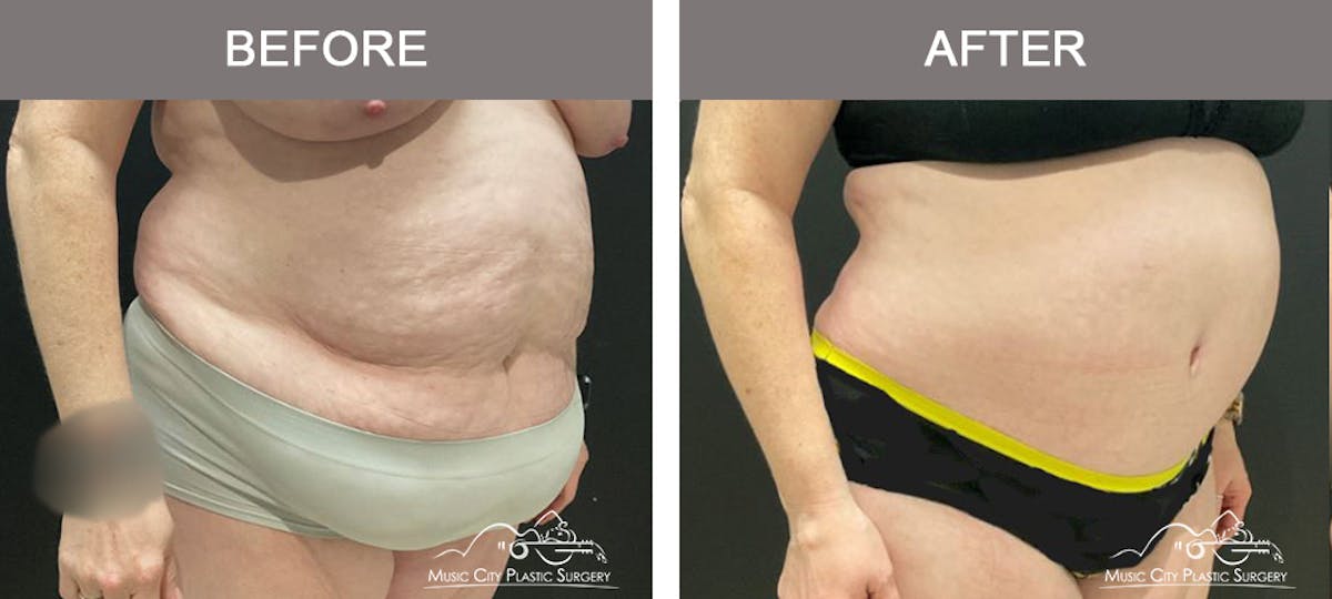 Liposuction Before & After Gallery - Patient 421183 - Image 2