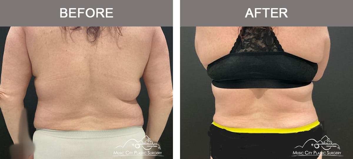 Liposuction Before & After Gallery - Patient 421183 - Image 6