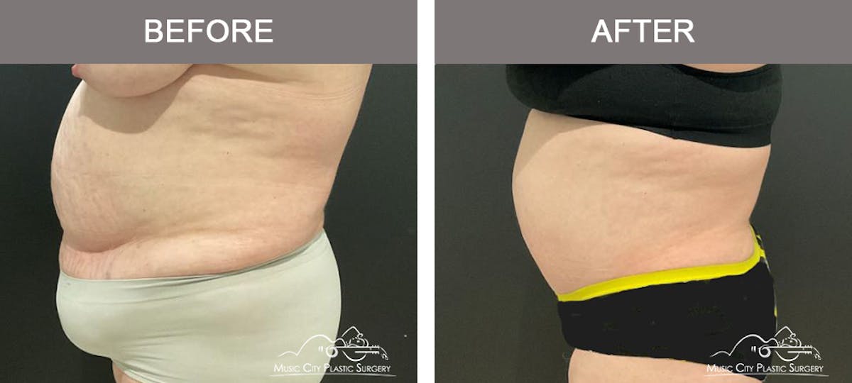 Abdominoplasty Before & After Gallery - Patient 198850 - Image 5