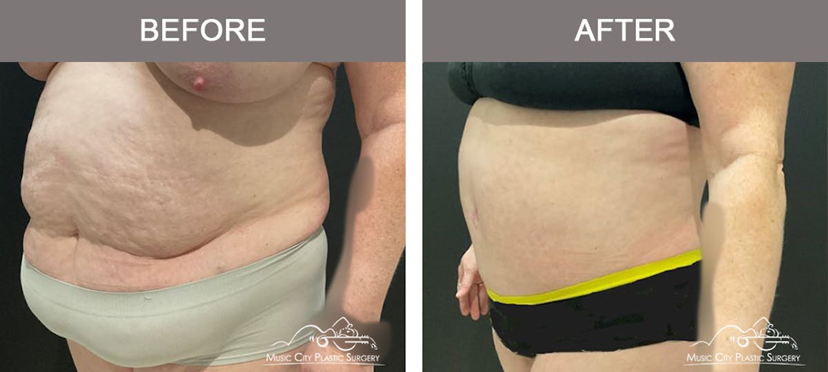 Abdominoplasty Before & After Gallery - Patient 198850 - Image 4