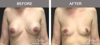 Mastopexy with Capsulectomy Before & After Gallery - Patient 289916 - Image 1