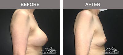 Mastopexy with Capsulectomy Before & After Gallery - Patient 289916 - Image 3