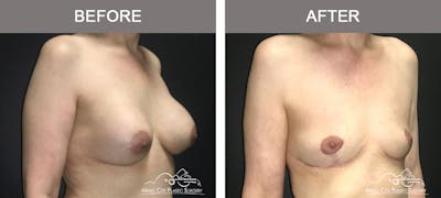 Mastopexy with Capsulectomy Before & After Gallery - Patient 289916 - Image 2