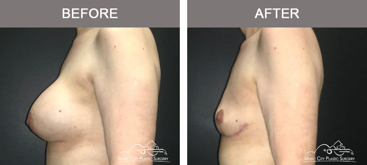 Mastopexy with Capsulectomy Before & After Gallery - Patient 289916 - Image 5