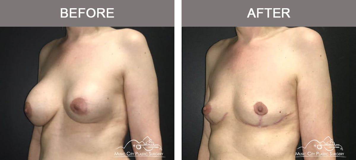 Mastopexy with Capsulectomy Before & After Gallery - Patient 289916 - Image 4