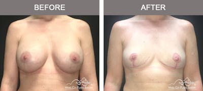 Mastopexy with Capsulectomy Before & After Gallery - Patient 152649 - Image 1