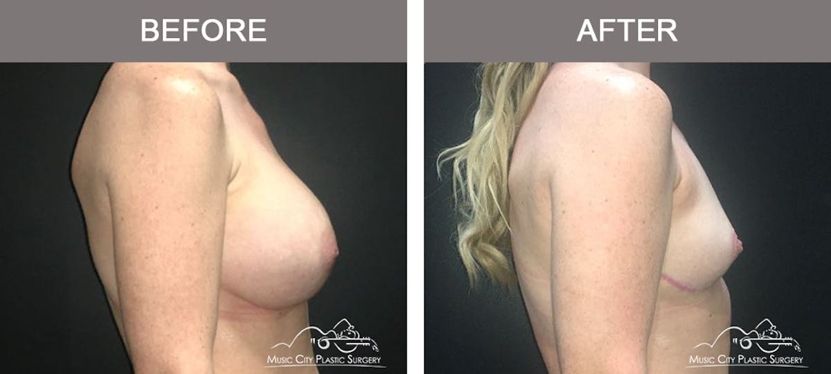 Mastopexy with Capsulectomy Before & After Gallery - Patient 152649 - Image 3
