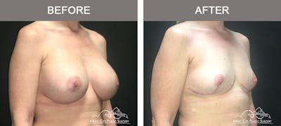 Mastopexy with Capsulectomy Before & After Gallery - Patient 152649 - Image 2