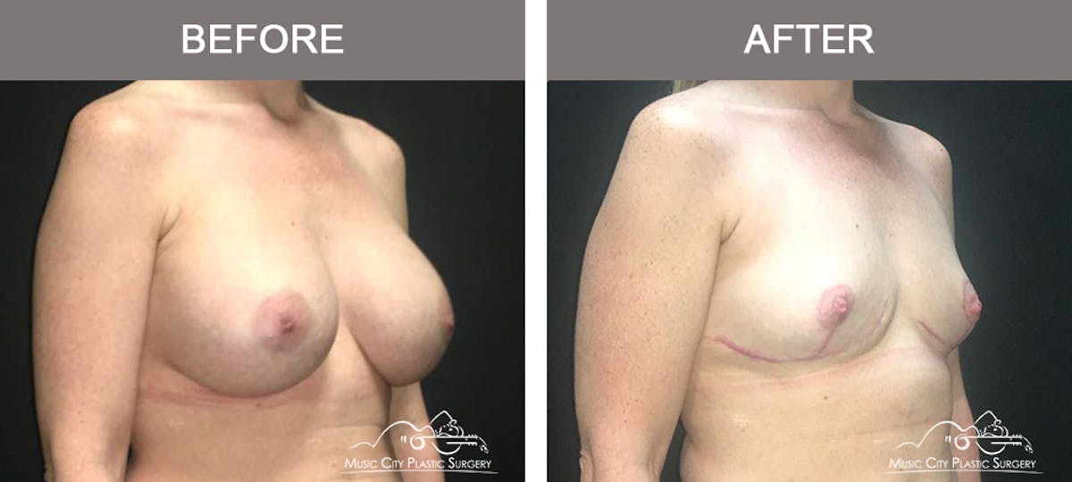 Mastopexy with Capsulectomy Before & After Gallery - Patient 152649 - Image 2