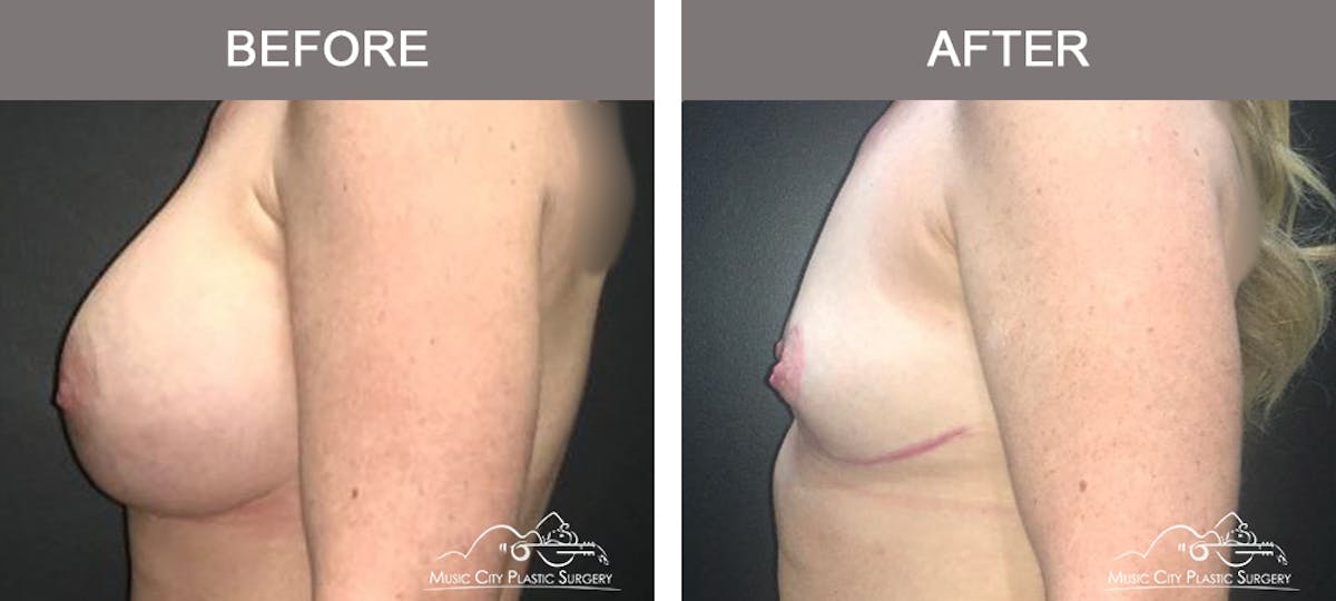 Mastopexy with Capsulectomy Before & After Gallery - Patient 152649 - Image 5