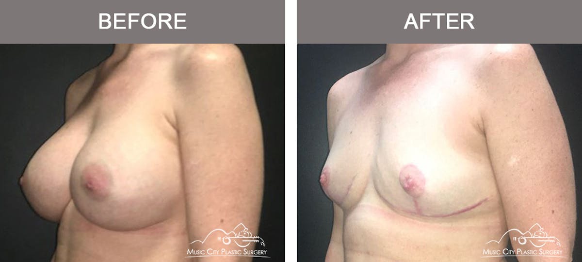 Mastopexy with Capsulectomy Before & After Gallery - Patient 152649 - Image 4